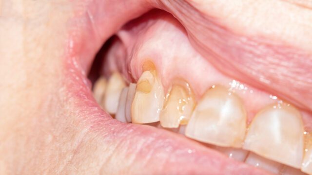 The Hidden Dangers of Gum Disease