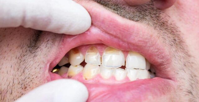 The Hidden Dangers of Gum Disease