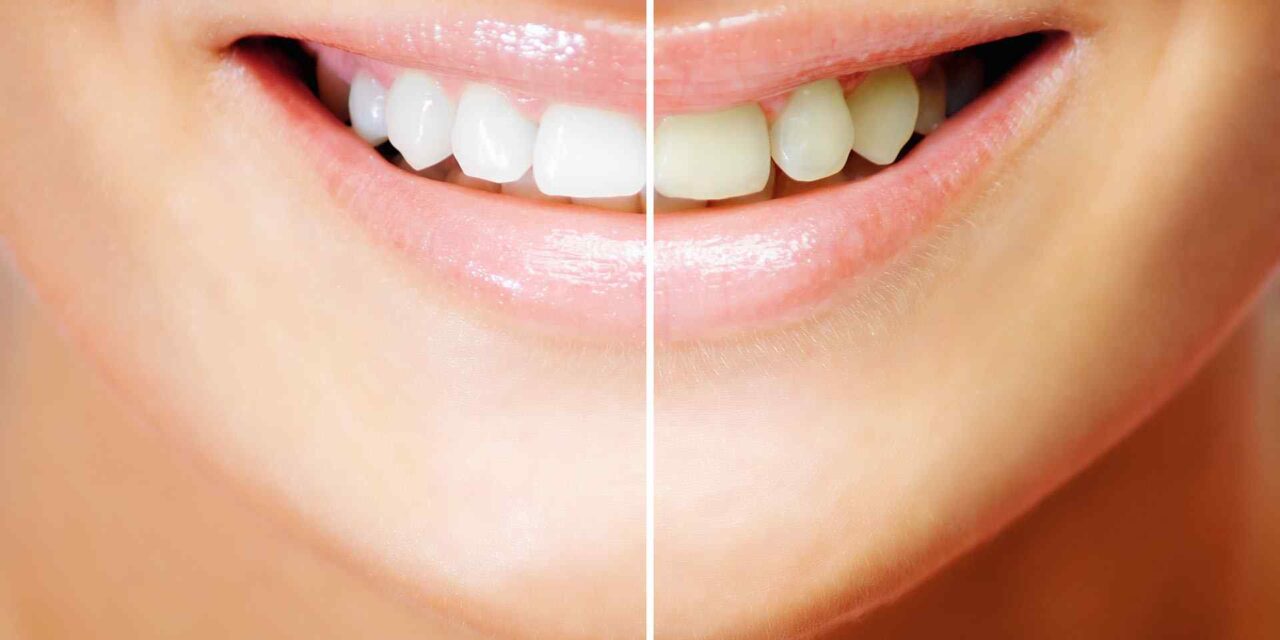 Do Whitening Strips Damage Teeth?