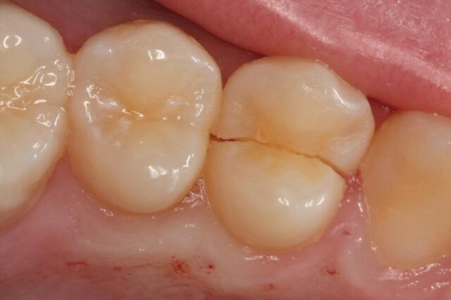 What Can Dentists Do To Minor Cracks in Tooth