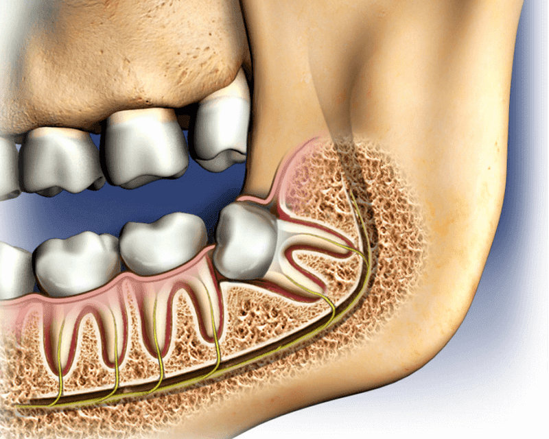 Cost of Wisdom Tooth Extraction – An Overview