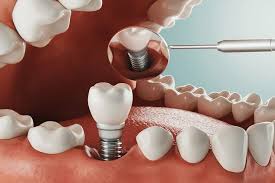 Importance of Advanced Diagnosis for Same Day Tooth Extraction and Implant