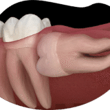 Cost of Wisdom Tooth Extraction varies