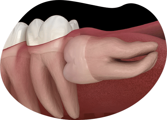 Cost of Wisdom Tooth Extraction varies