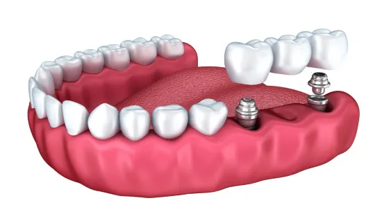 A Guide To Same Day Tooth Extraction and Implant