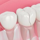 Understanding Minor Tooth Cracks and What Can Dentists Do To Minor Cracks in Tooth?