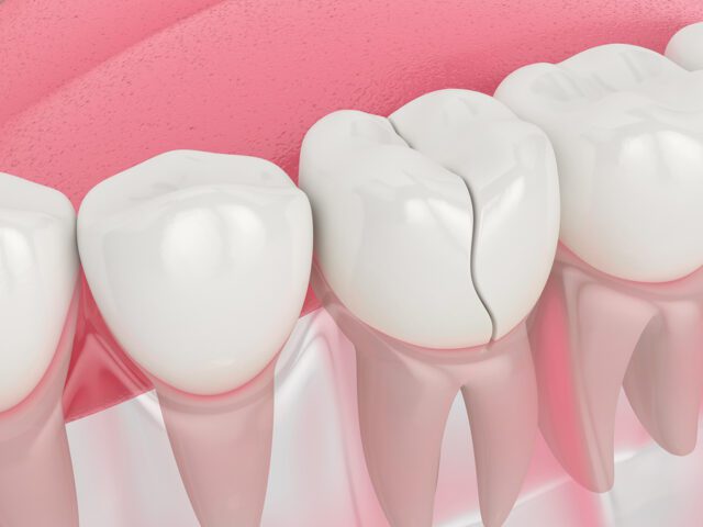 Understanding Minor Tooth Cracks and What Can Dentists Do To Minor Cracks in Tooth?