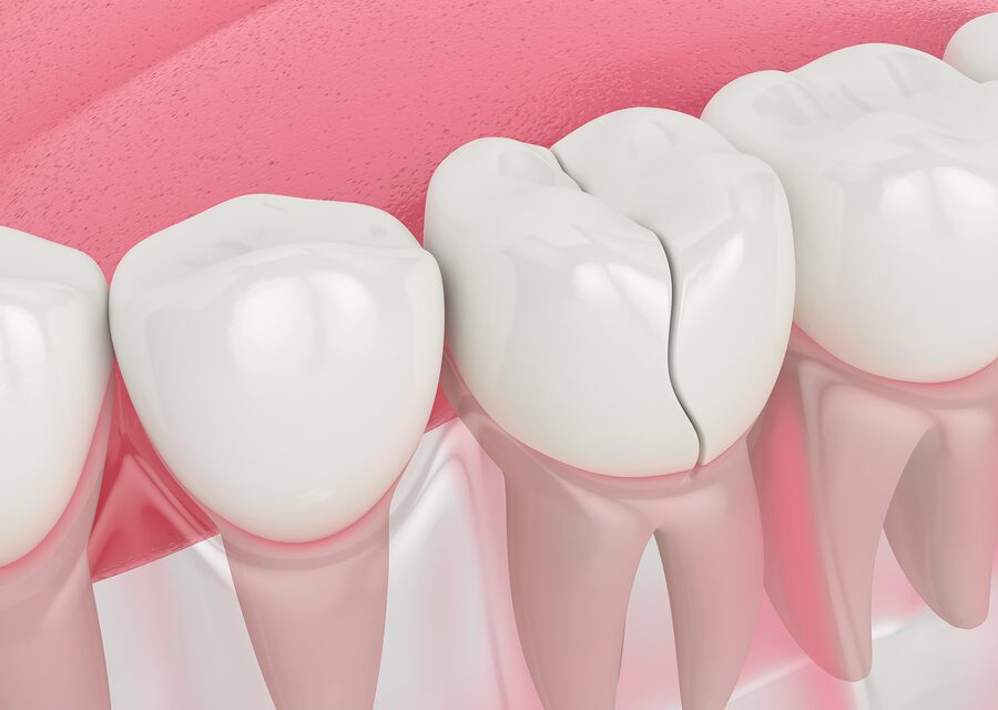 What Can Dentists Do To Minor Cracks in Tooth